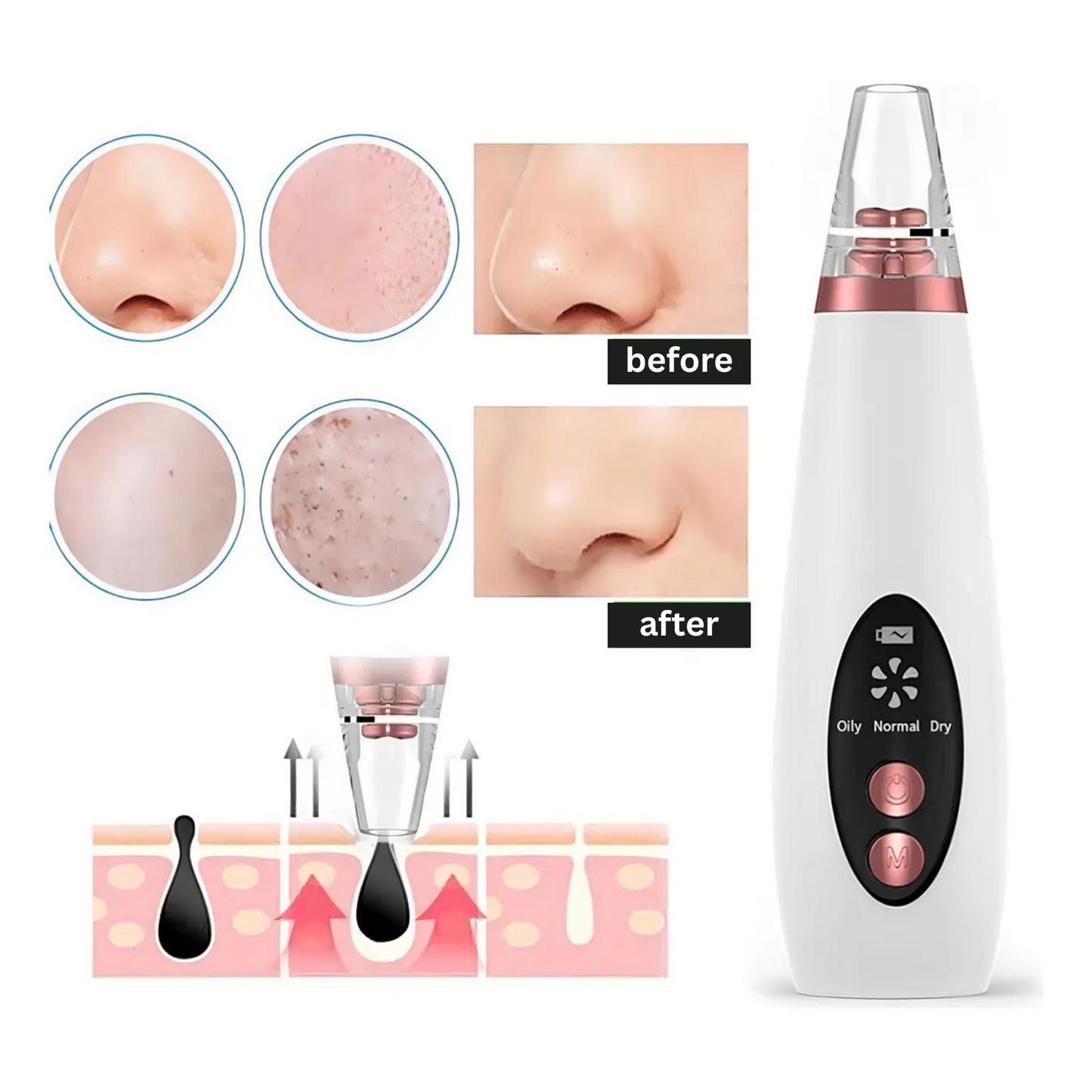PoreVac Pro Blackhead Remover